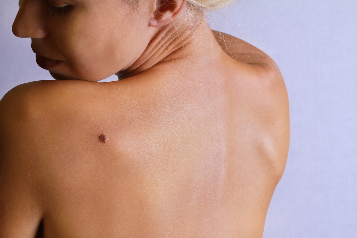 Young woman lookimg at birthmark on her back, skin. Checking benign moles
