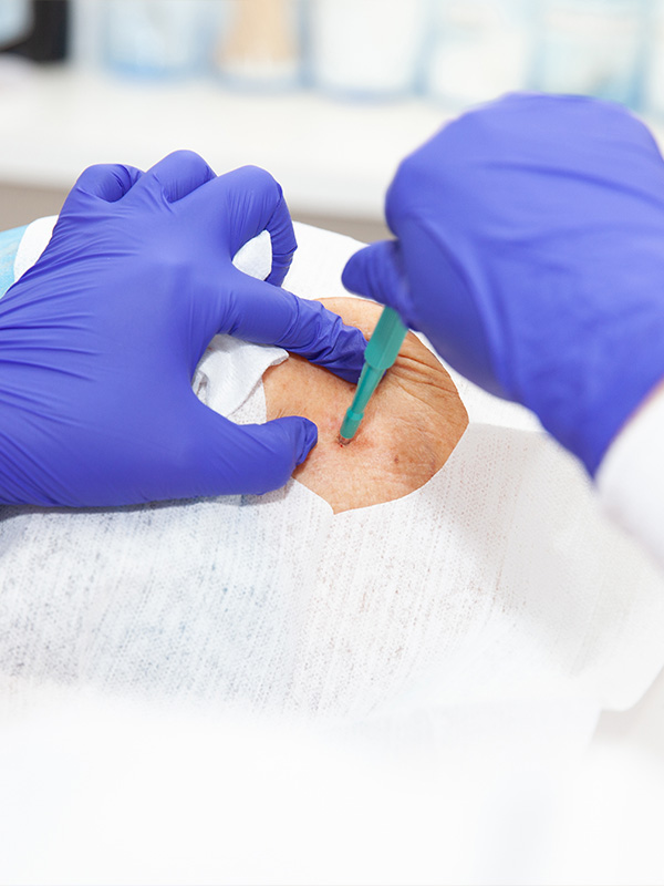 biopsy1