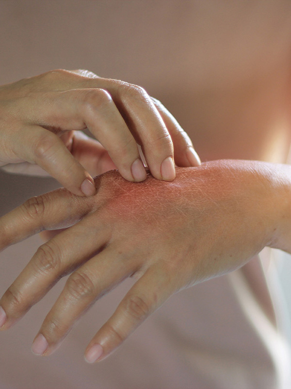 eczema-1
