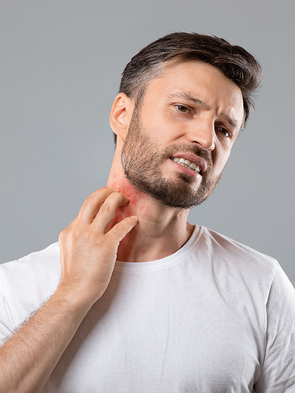 eczema2