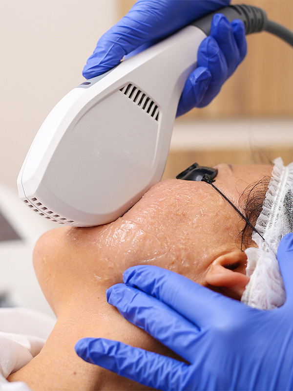 ipl-treatment1