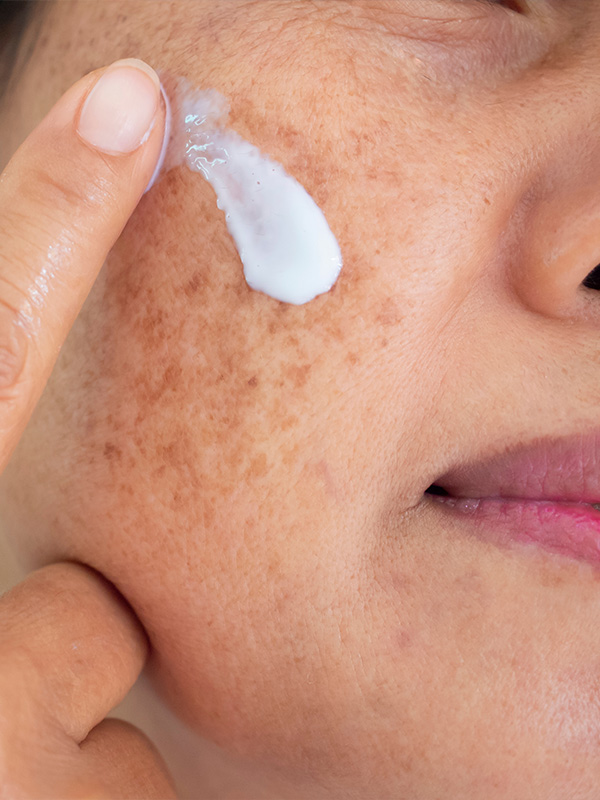 melasma1