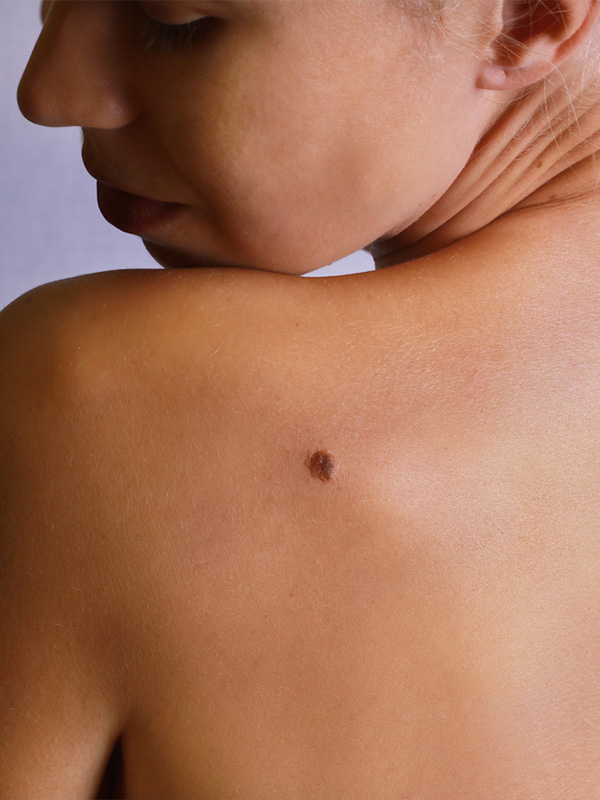 moles-1