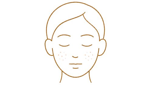 rosacea