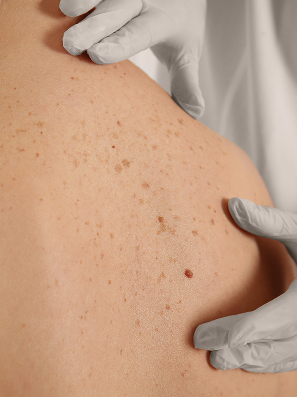 skincancer2